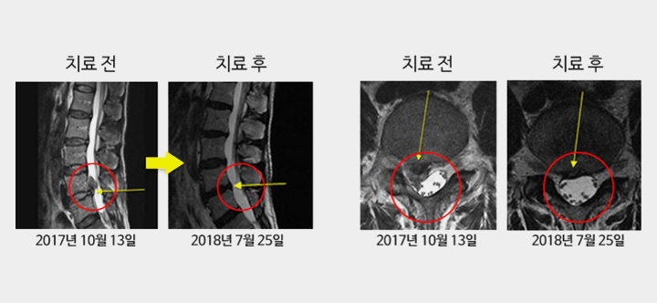 대전한방병원의 도침요법을 받은 요추 추간판 탈출증 환자의 치료 전후 MRI 사진 비교 결과 도표